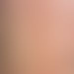 Lichen myxoedematosus. densely standing, skin-colored, clearly increased in consistency, only sli...