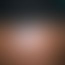 Lichen planus actinus: polygonal begrezter, kaum juckender&nbsp;Lichen planus. Im Randbereich der...
