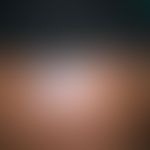 Lichen planus actinus: polygonal begrezter, kaum juckender&nbsp;Lichen planus. Im Randbereich der...