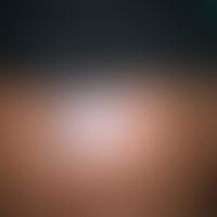 Lichen planus actinus: polygonal begrezter, kaum juckender&nbsp;Lichen planus. Im Randbereich der...