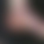 Lichen planus atrophicans. atrophying lichen planus existing for 10 years, which manifested itsel...