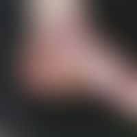 Lichen planus atrophicans. atrophying lichen planus existing for 10 years, which manifested itsel...