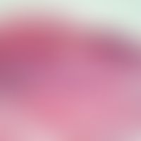 Lichen planus bullosus. Ausgeprägte "Interface-Dermatitis" mit Atrophie des Epithels bei Hypergra...