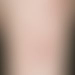 Lichen planus exanthematicus: shiny polygonal papules that aggregate to larger rhomboid structure...