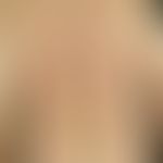Lichen planus exanthematicus. 4 months old, distinctly itchy exanthema with pinhead-sized, slight...