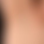 Lichen planus exanthematicus, reddish, polygonal, lichenoid papules, partly with brownish hyperpi...