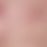 Lichen planus exanthematicus. 32-year-old patient with this clinical picture, which developed wit...