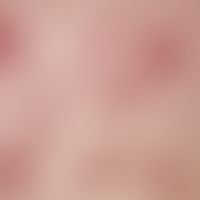 Lichen planus exanthematicus. 32-year-old patient with this clinical picture, which developed wit...