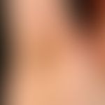 Lichen planus exanthematicus. besides the signs of exanthematic lichen planus, obesity induced ac...