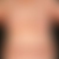 Lichen planus exanthematicus. symmetricgeneralized distribution pattern of Lichen planus. the den...