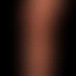 Lichen planus exanthematicus: since 2 months persistent, itchy, generalized, dense rash with emph...