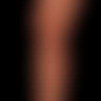 Lichen planus exanthematicus: since 2 months persistent, itchy, generalized, dense rash with emph...