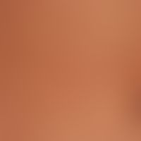Lichen planus exanthematicus: small papular lichen planus with aggregation of the efflorescences ...