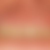 Lichen planus mucosae. veil-like, blurred, whitish, sometimes also reddish (right side) plaques o...