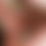 Lichen planus mucosae. small spots (splashes) of white or opaline stains and papules of the bucca...