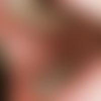 Lichen planus mucosae. small spots (splashes) of white or opaline stains and papules of the bucca...