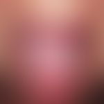Lichen planus mucosae. 64-year-old, otherwise healthy woman. no skin lesions. mucous membrane les...