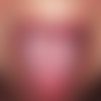 Lichen planus mucosae. 64-year-old, otherwise healthy woman. no skin lesions. mucous membrane les...