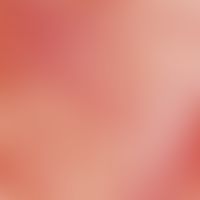 Lichen planus mucosae. reflected light microscopy: lower lip of a 37-year-old woman. whitish opaq...
