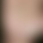 Lichen planus palmoplantaris. 45-year-old man has suddenly appeared, strongly itching, reddened, ...