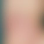 Lichen planus. large-area lichen planus formed by aggregation of small papules (see upper edge of...