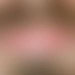 Lichen planus: Completely asymptomatic, partly striated and partly anular lichen planus of the lo...