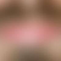 Lichen planus: Completely asymptomatic, partly striated and partly anular lichen planus of the lo...