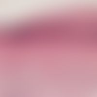 Lichen planus:&nbsp;Detailvergrößerung: Interface-Dermatitis mit sägezahnartiger Akanthose. Chara...