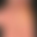 Lichen planus (classic type): itchy, polygonal, partially confluent, brownish-reddish papules on ...