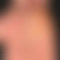 Lichen planus (classic type): itchy, polygonal, partially confluent, brownish-reddish papules on ...