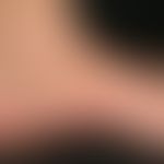 Lichen planus. chronically active, multiple, increasing, disseminated standing, partly confluent,...