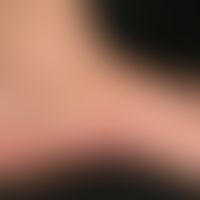 Lichen planus (klassischer Typ):&nbsp;chronisch aktive, multiple, zunehmende, disseminiert stehen...