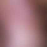 Lichen planus. in a 34-year-old man there are whitish, partly circulatory smooth plaques in the a...