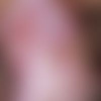 Lichen planus. in a 34-year-old man there are whitish, partly circulatory smooth plaques in the a...