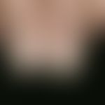 Lichen planus. findings increasing since several years. distinct longitudinal rippling of the nai...