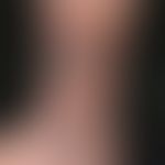 Lichen planus verrucosus: Large, coarse, brownish to brownish-red plaques with a verrucous surfac...