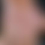 lichen (planus) verrucosus. multiple, chronically stationary, blurred, itchy, reddish, rough (war...