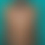 Lichen (planus) verrucosus in linear arrangement (ILVEN under the image of Lichen (planus) verruc...
