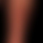Lichen planus verrucosus, a hypertrophic lichen planus with pseudoepitheliomatous epithelial hype...