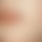 Lichen sclerosus et atrophicus, whitish shining plaque with atrophy of skin and subcutis in the a...