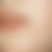 Lichen sclerosus et atrophicus, whitish shining plaque with atrophy of skin and subcutis in the a...