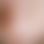 Lichen sclerosus et atrophicus, whitish shining, focal hemorrhagic, follicle-bound maculae in the...