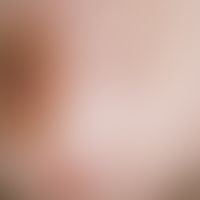 Lichen sclerosus et atrophicus, whitish shining, focal hemorrhagic, follicle-bound maculae in the...