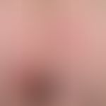 Lichen sclerosus et atrophicus: General view of a bullous form: In the region of the lower right ...