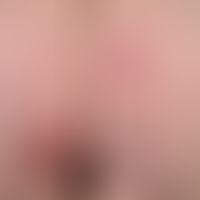 Lichen sclerosus et atrophicus: General view of a bullous form: In the region of the lower right ...
