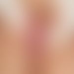 Lichen sclerosus et atrophicus: Solitary, chronically stationary, approx. 2.5 x 1.0 cm large, sym...