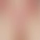 Lichen sclerosus et atrophicus. hourglass phenomenon with classic whitish-porcelain-like skin on ...