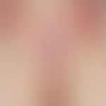 Lichen sclerosus et atrophicus. hourglass phenomenon with classic whitish-porcelain-like skin on ...