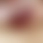 Lichen sclerosus et atrophicus: Acute, laminar, partly hemorrhagic blister formation with underly...