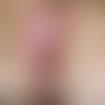 Lichen sclerosus et atrophicus. pinhead-sized, in places confluent, whitish shining papules. comp...